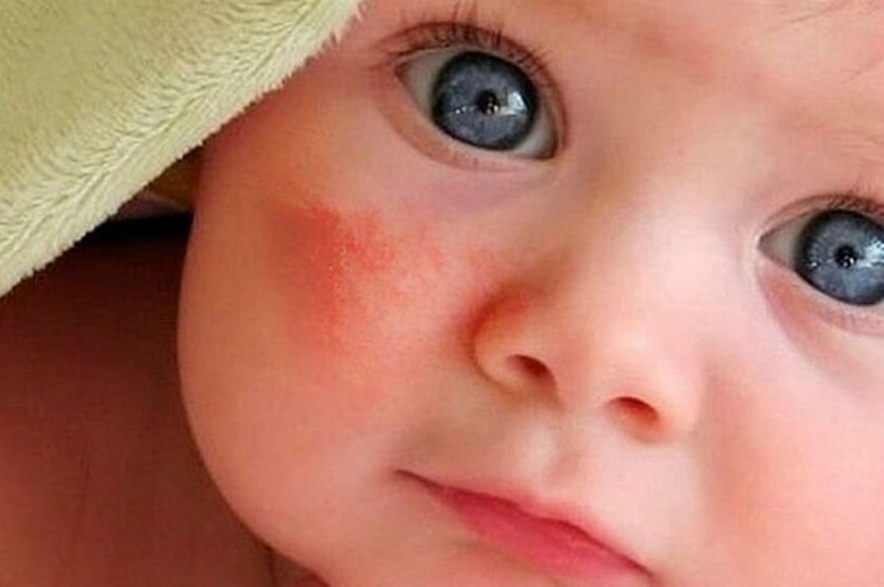 Mẹo Chữa Chàm Sữa Cho Bé Bằng Phương Pháp Dân Gian