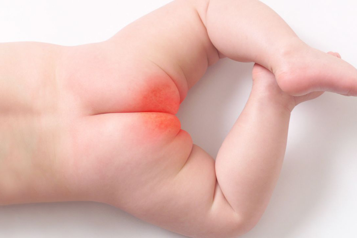 Hăm Tã Ở Trẻ Cẩm Nang Từ A >z Cho Ba Mẹ