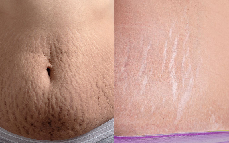 [hỎi ĐÁp] Các Vấn Đề Liên Quan Đến Rạn Da Ở Mẹ Bầu Và Sau Sinh