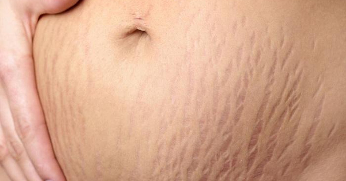 Làm Sao Để Ngăn Ngừa Rạn Da Ở Bụng Khi Mang Thai